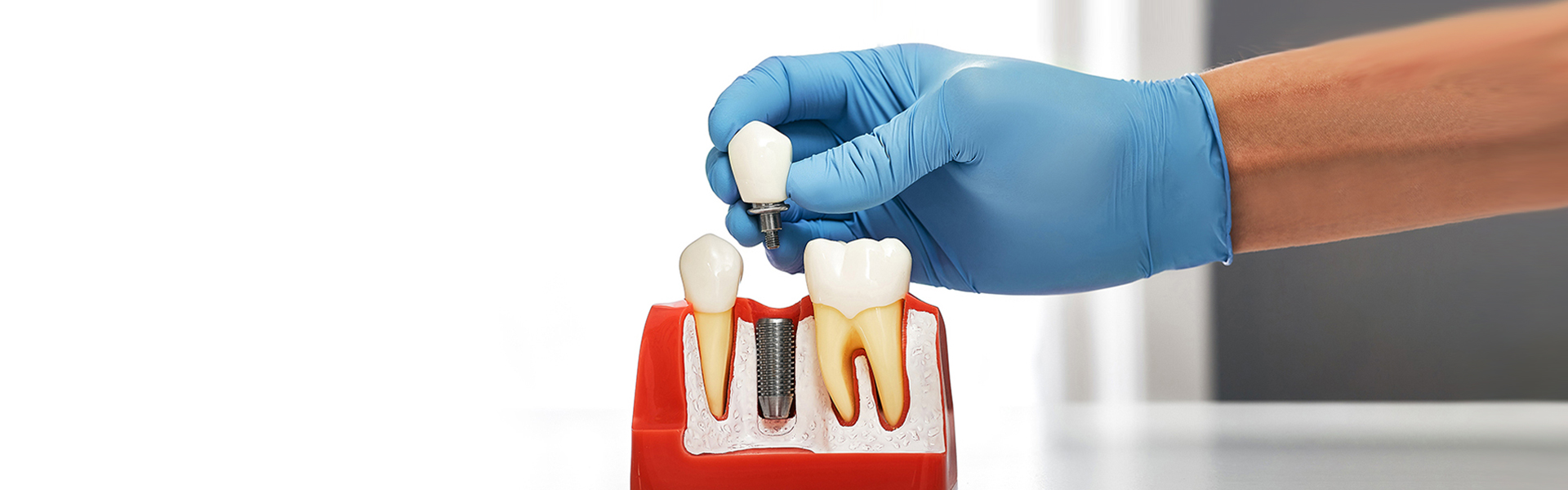 What Factors Decide the Number of Dental Implants Needed?